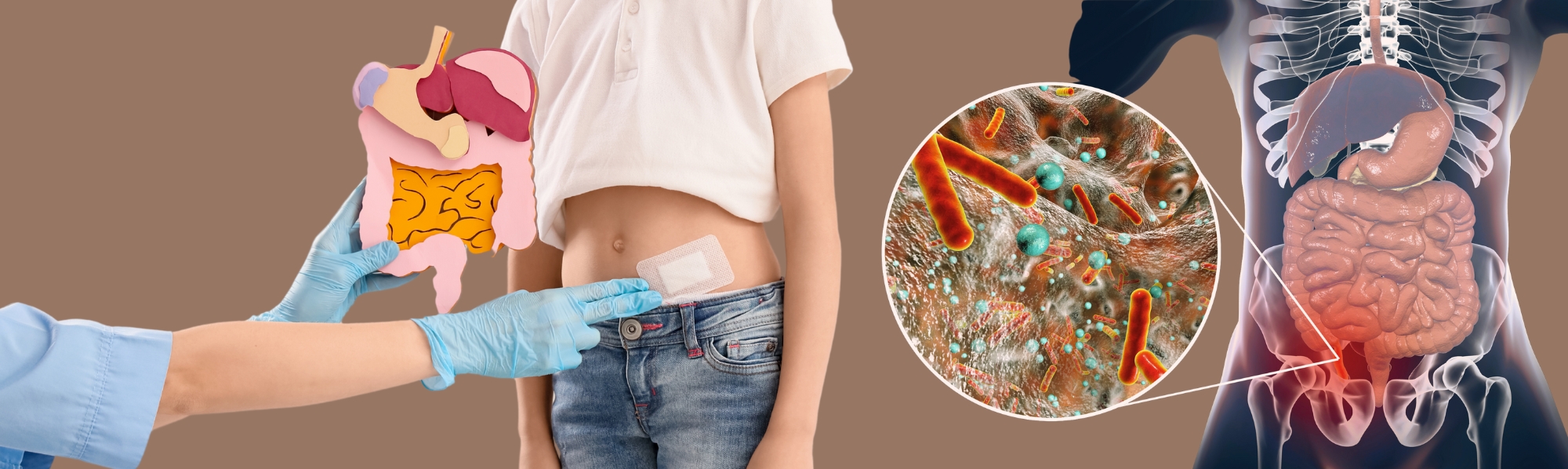 How an Appendectomy Can Lead to Hernia Formation? 