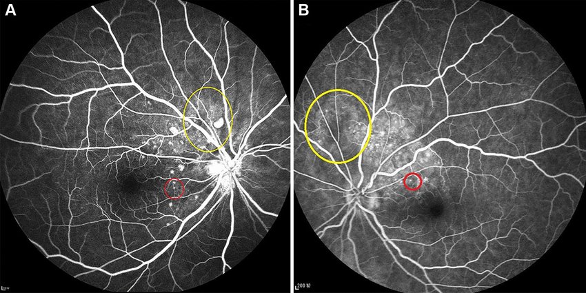 Ophthalmology - Fluorescein Angiography