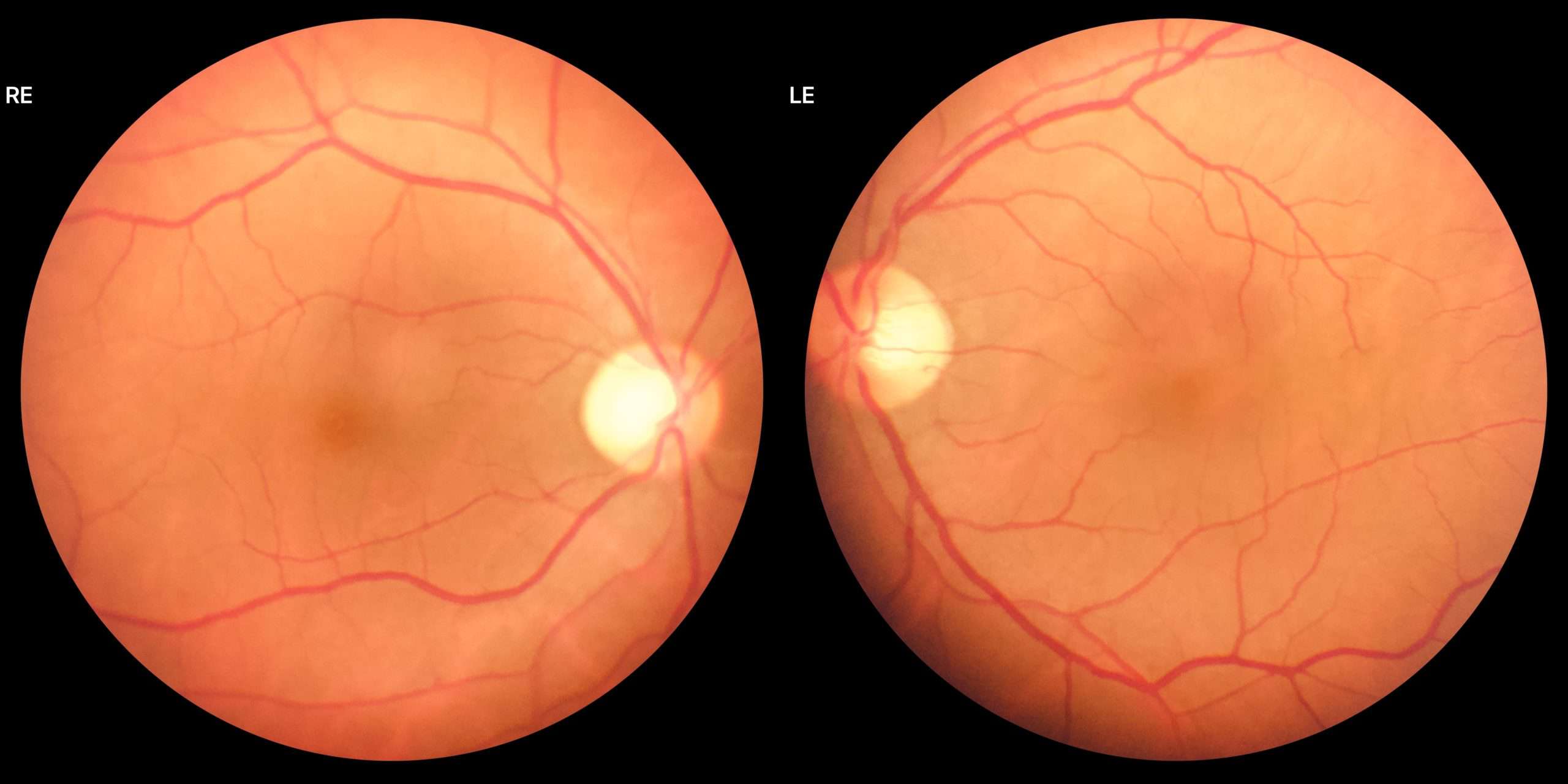 Ophthalmology - Fundus Photography