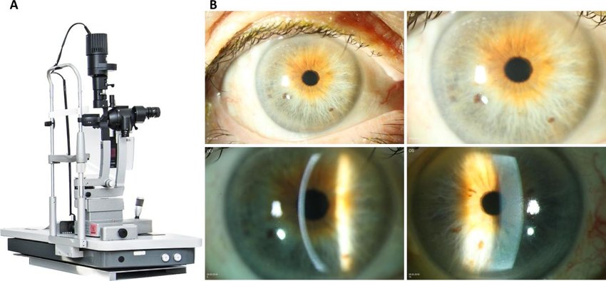 Ophthalmology - Ultrasound Biomicroscopy (UBM)