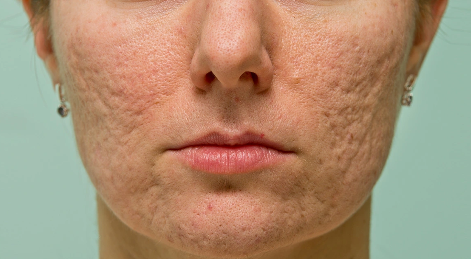 Skin Rejuvenation and Scar Treatment