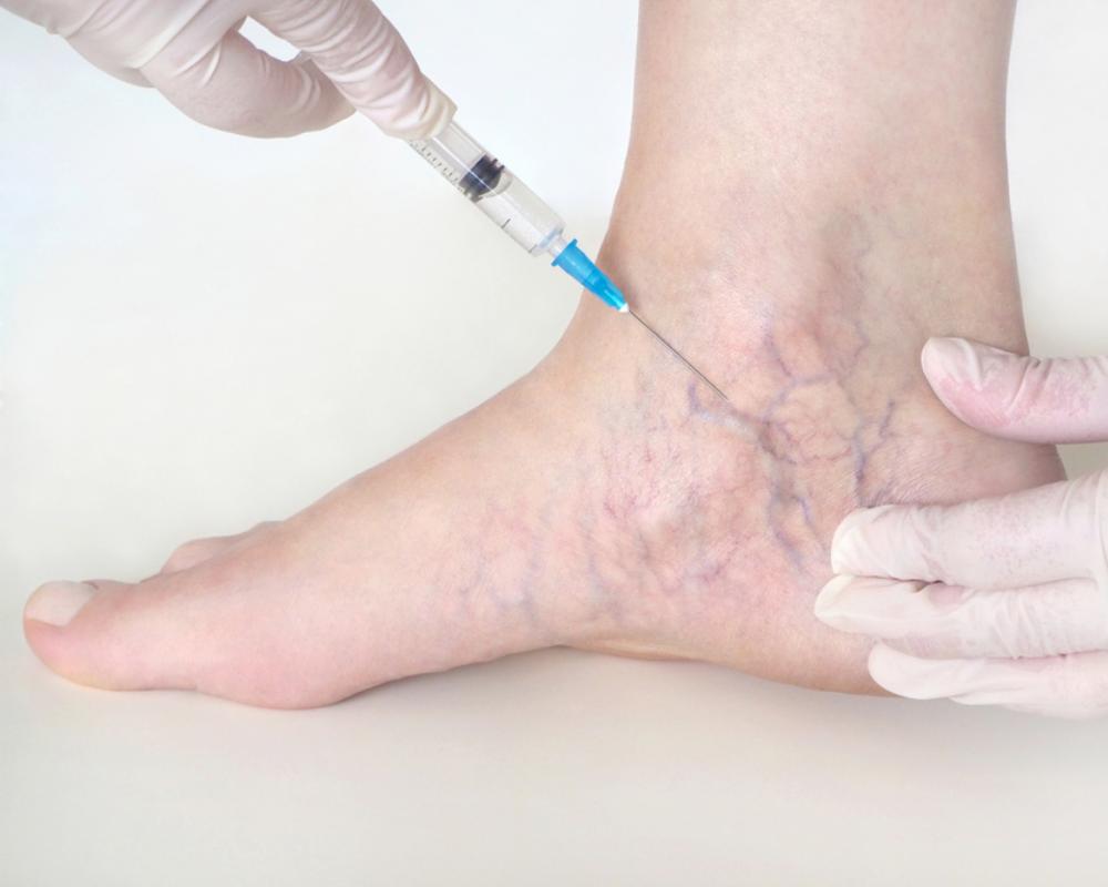 Varicose Vein Treatment