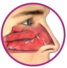 Allergic Rhinitis Management