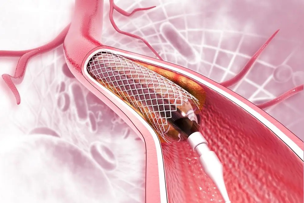 Interventional Cardiology (There are no cuts)