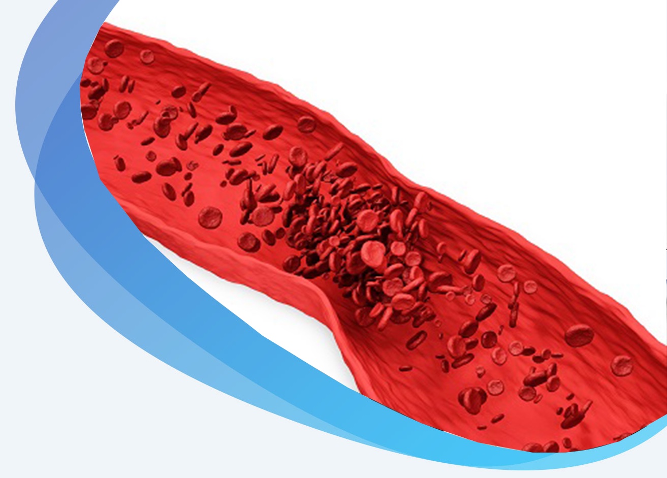 Stroke Management
