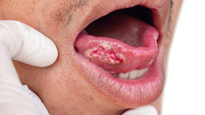 Oral Cancer Surgery