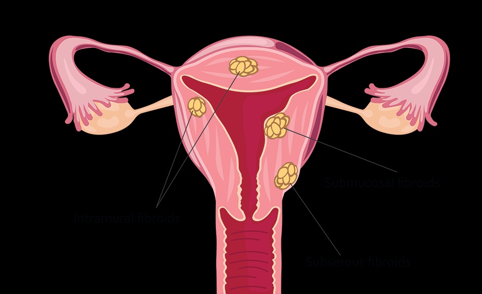 Uterine Fibroid Treatment