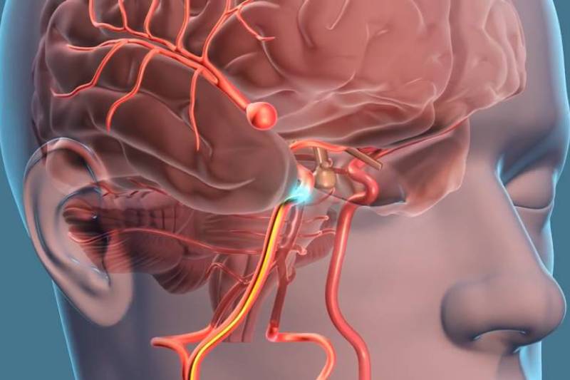Cerebrovascular Surgery