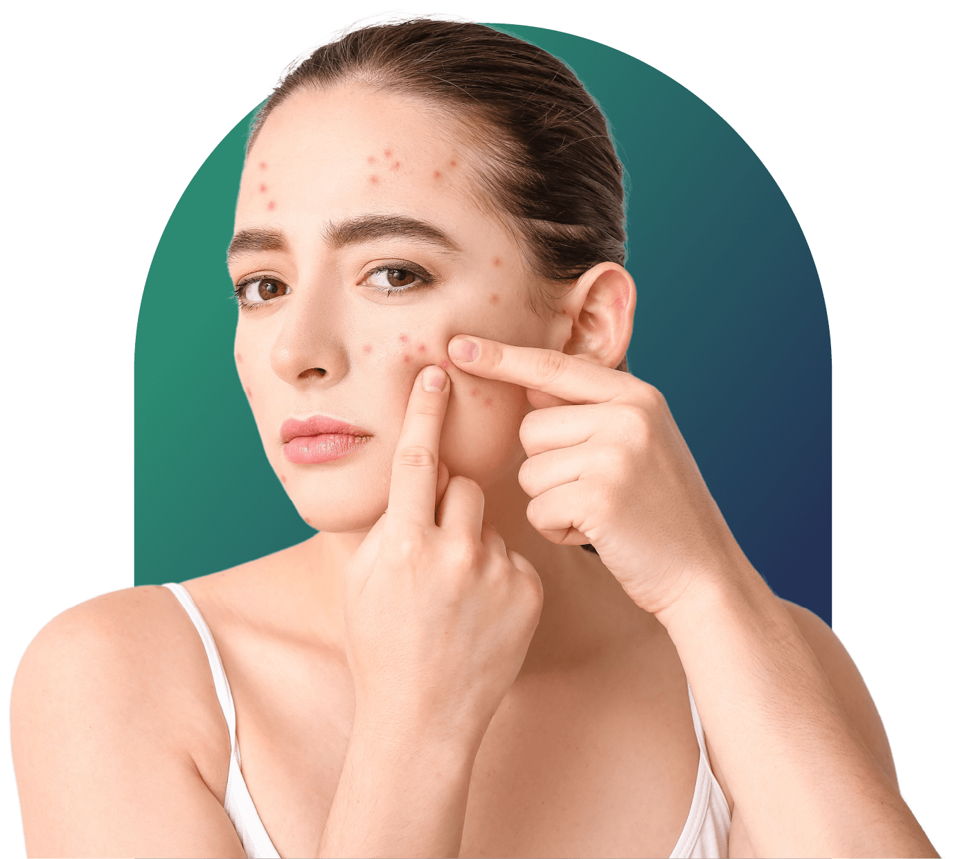 Acne Treatment