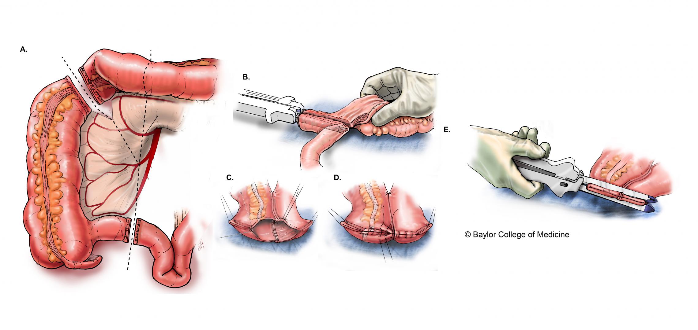 Bowel Resection