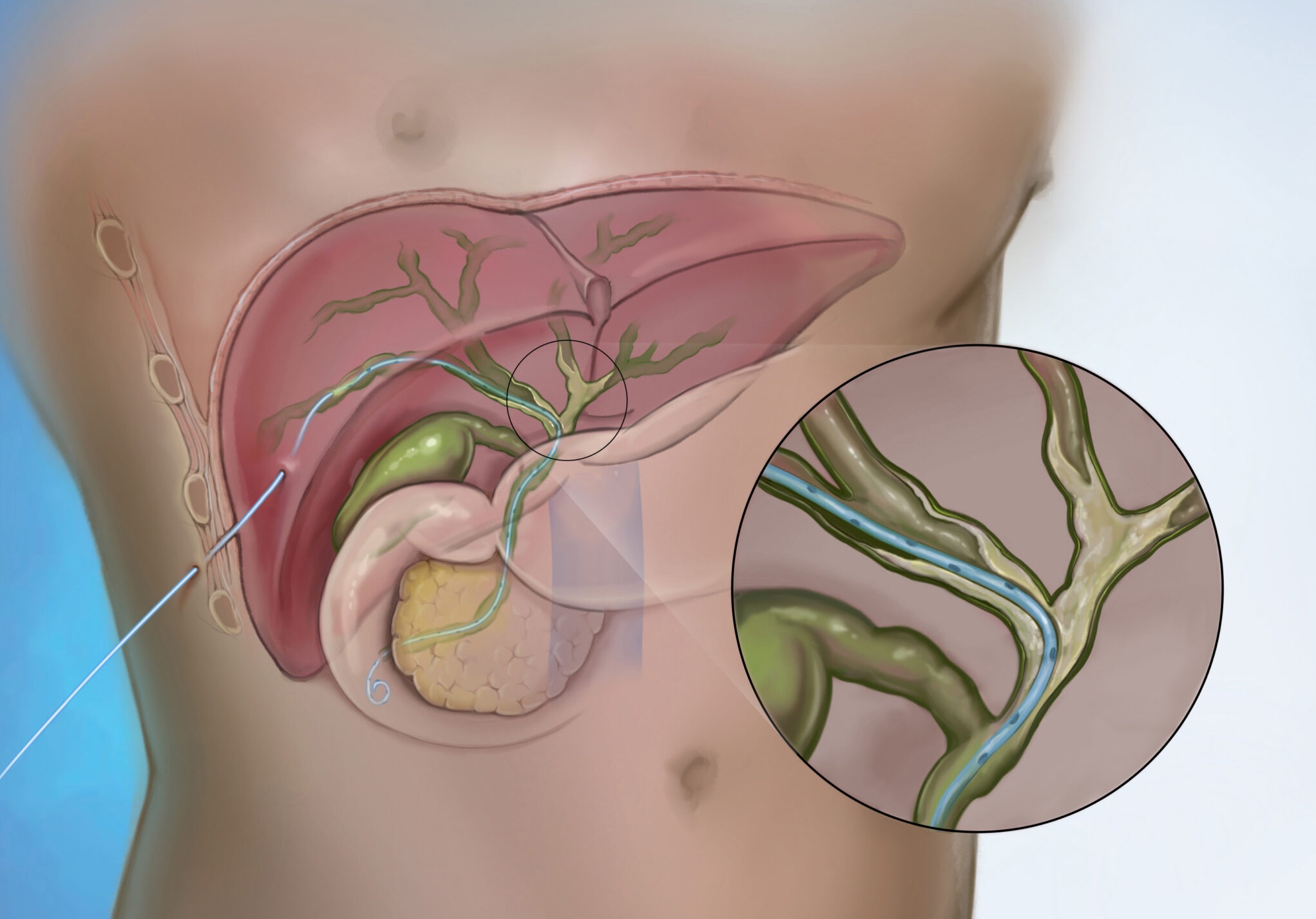 Biliary Drainage and Stent Placement