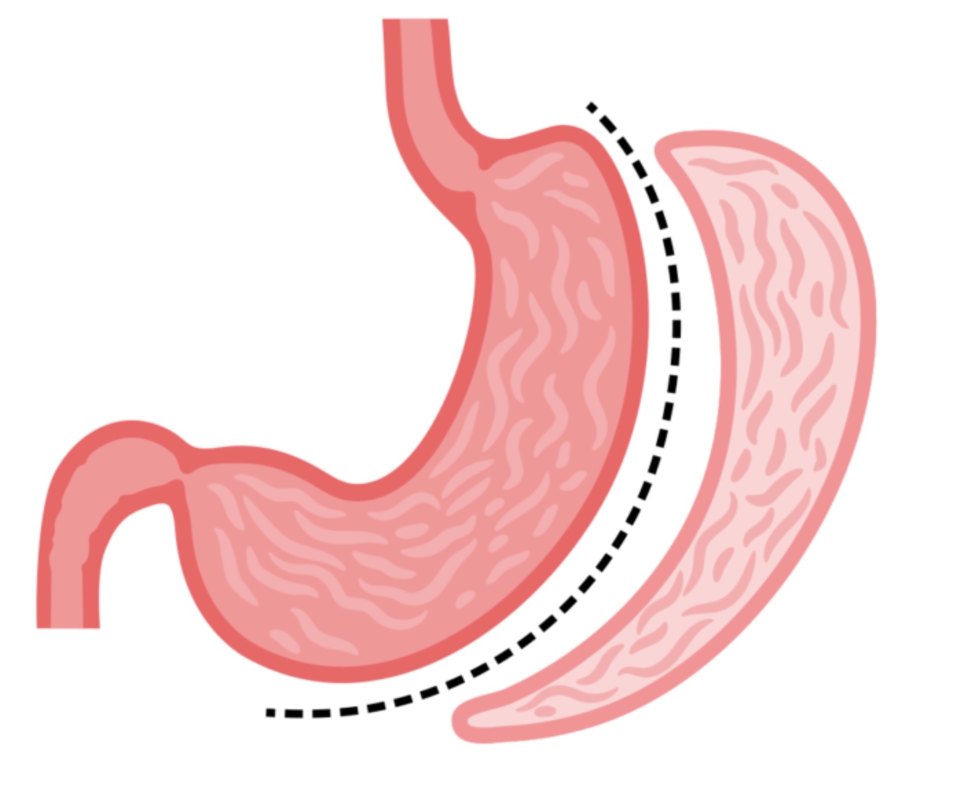Sleeve Gastrectomy