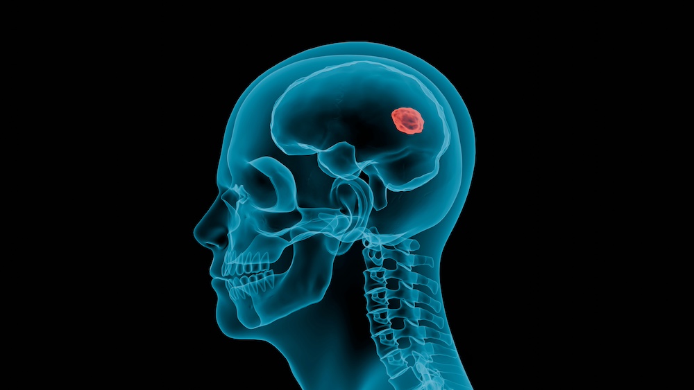 Brain Tumour Surgery