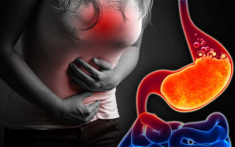 Acid Reflux and GERD