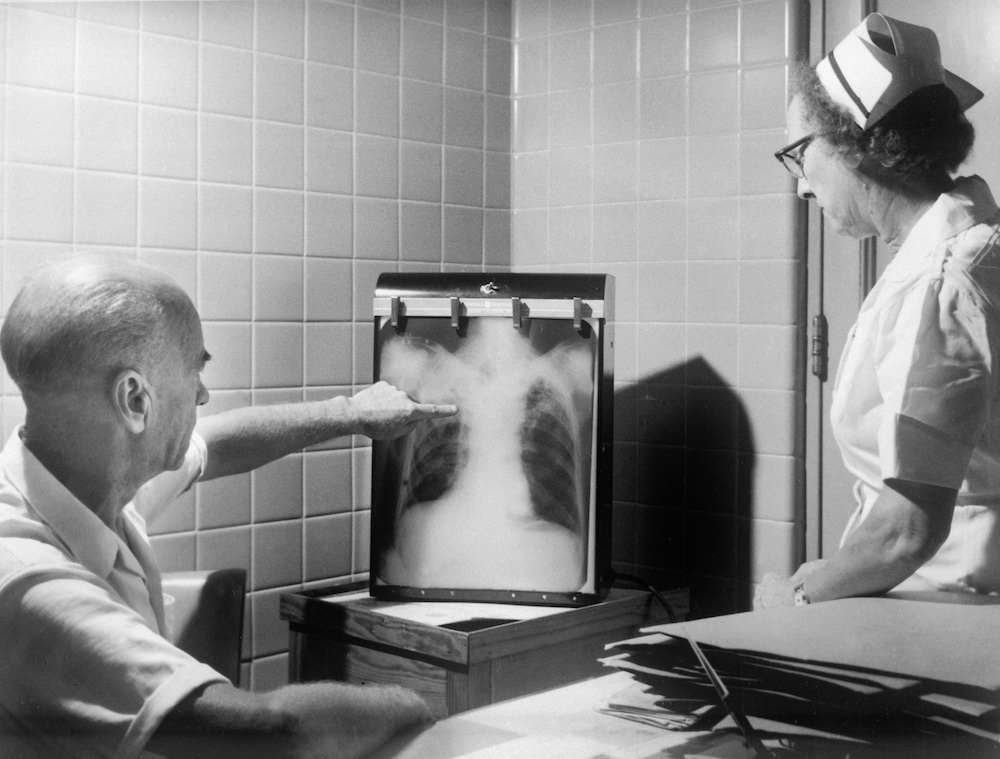 Tuberculosis (TB) Treatment