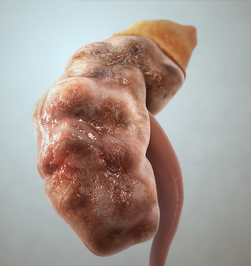 Chronic Kidney Disease (CKD) Management