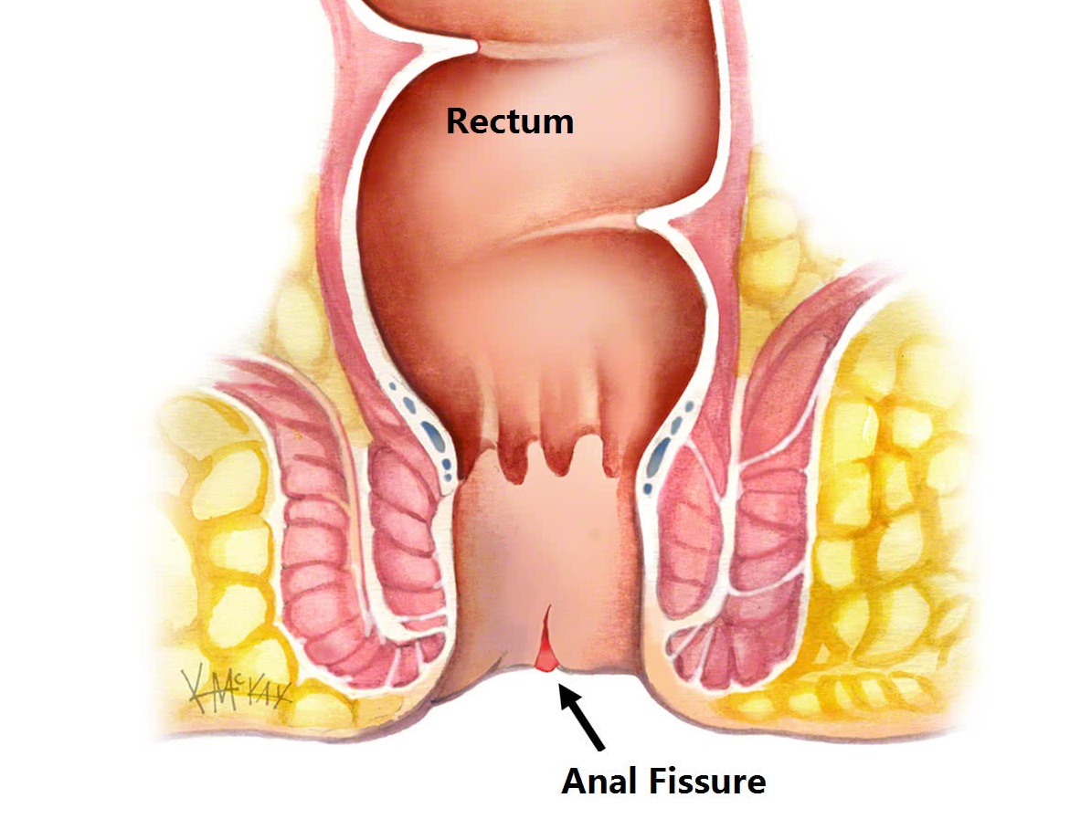 Fissures