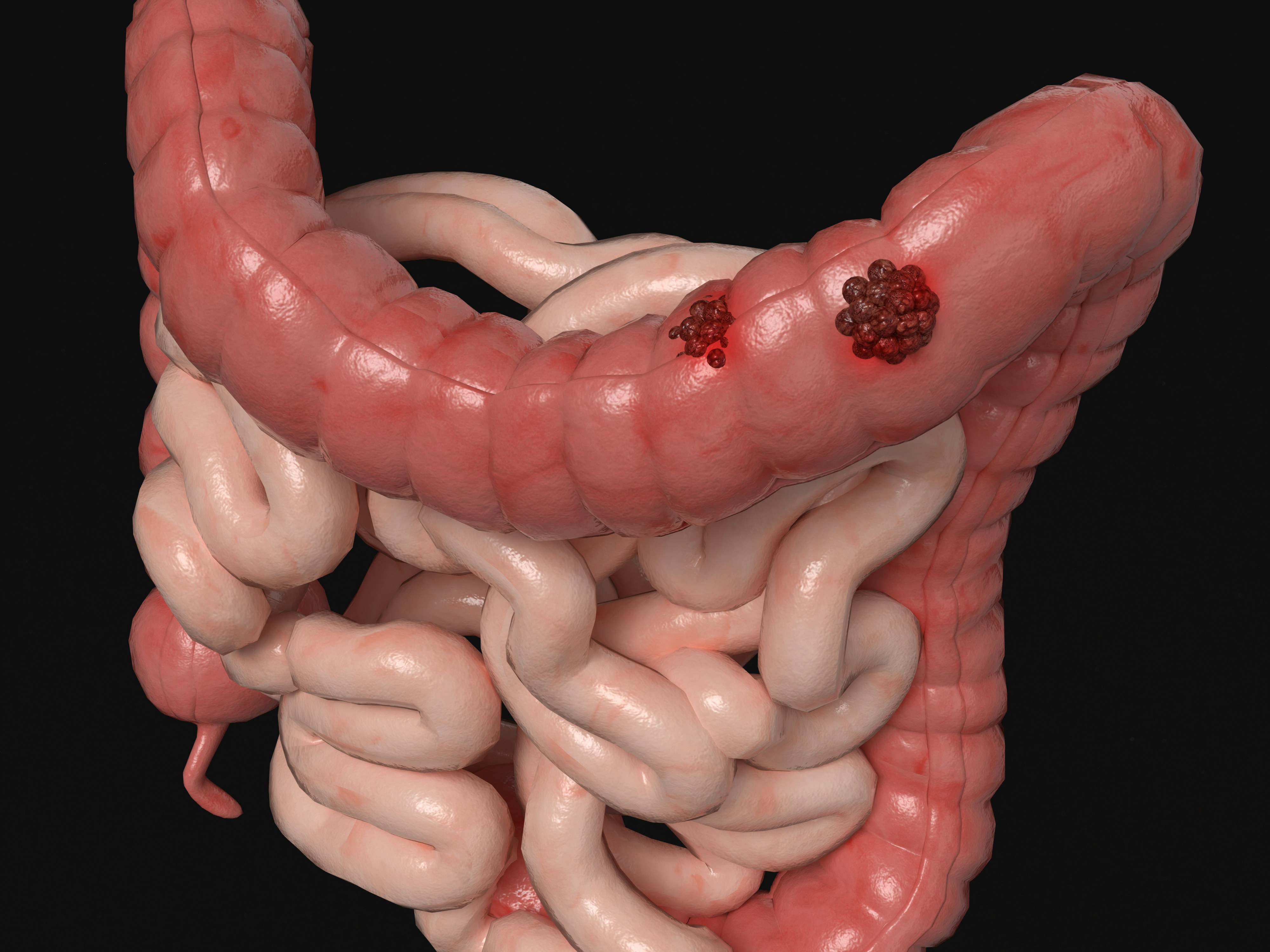 Colorectal Cancer Diagnosis and Treatment