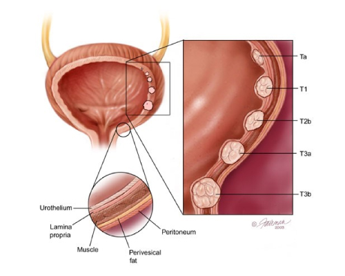 Bladder and Kidney Cancer