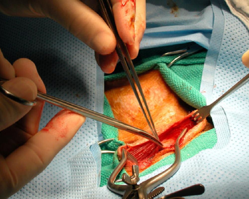 Peripheral Artery Disease (PAD) Surgery