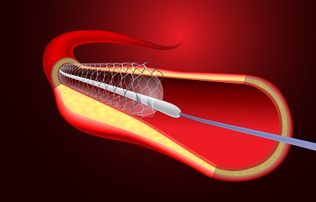 Angioplasty and Stent Placement