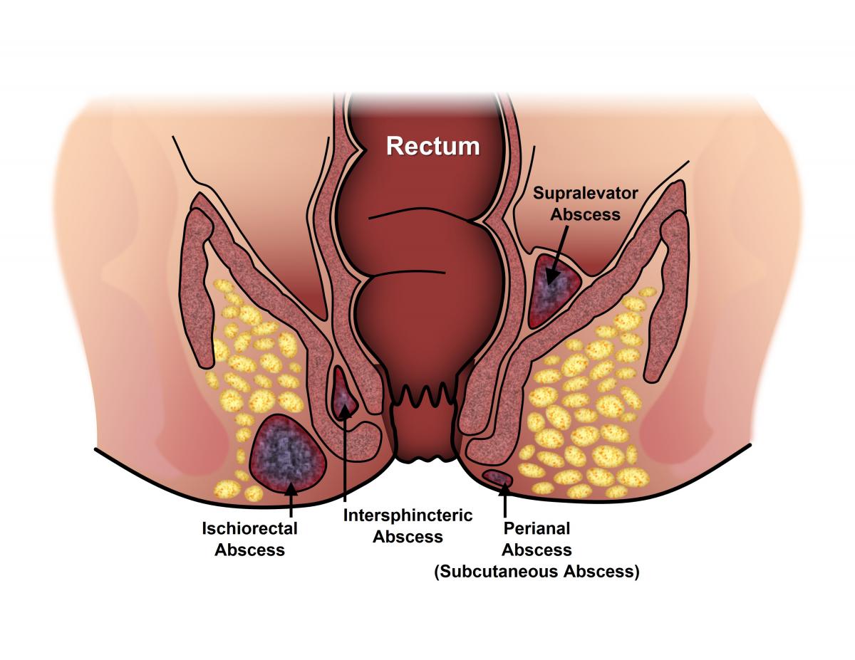 Abscesses