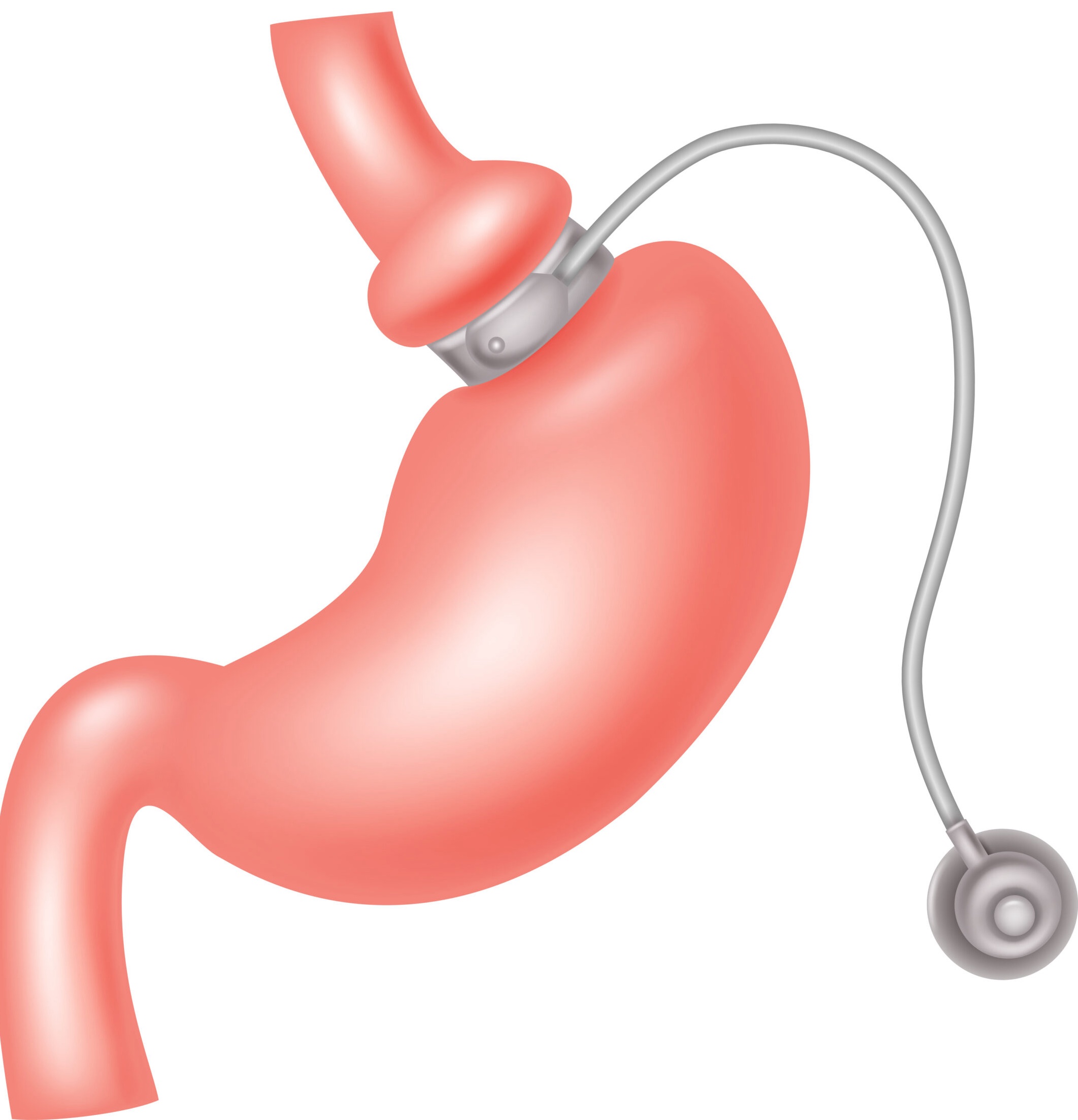Adjustable Gastric Banding (Lap-Band)
