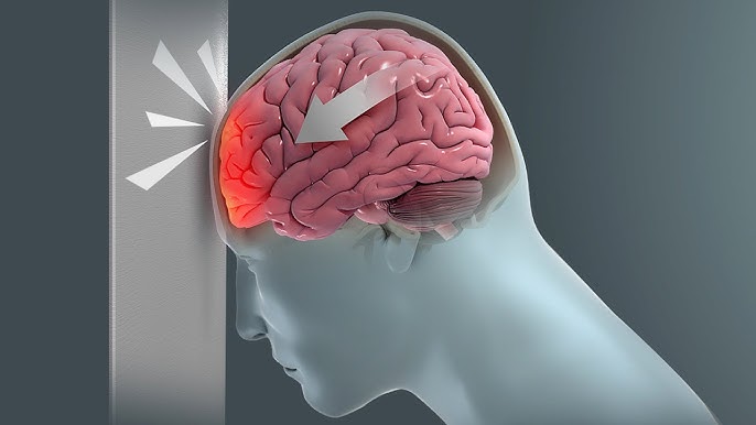 Traumatic Brain Injury (TBI) Surgery