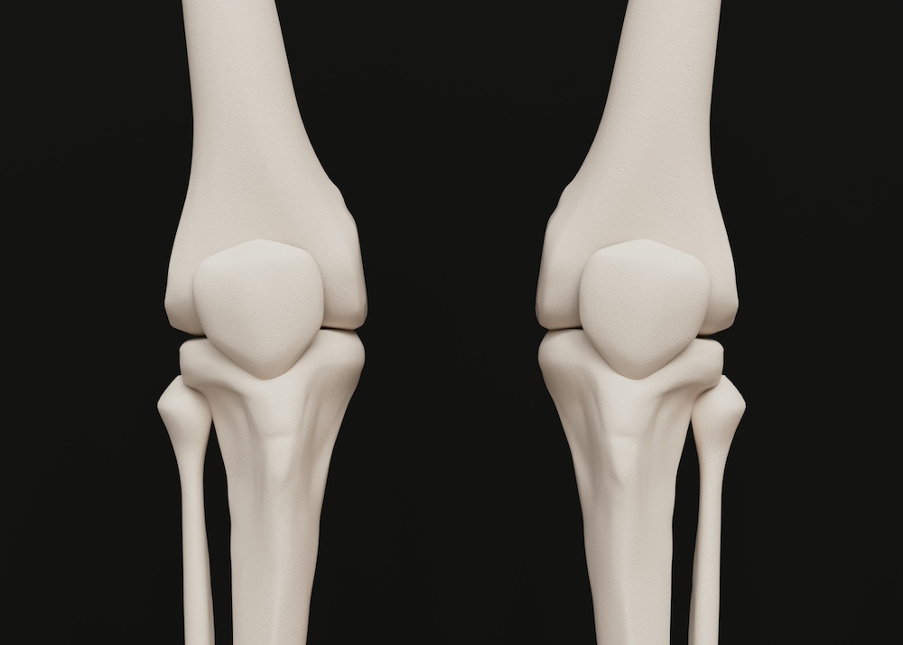 Joint Replacement Surgery