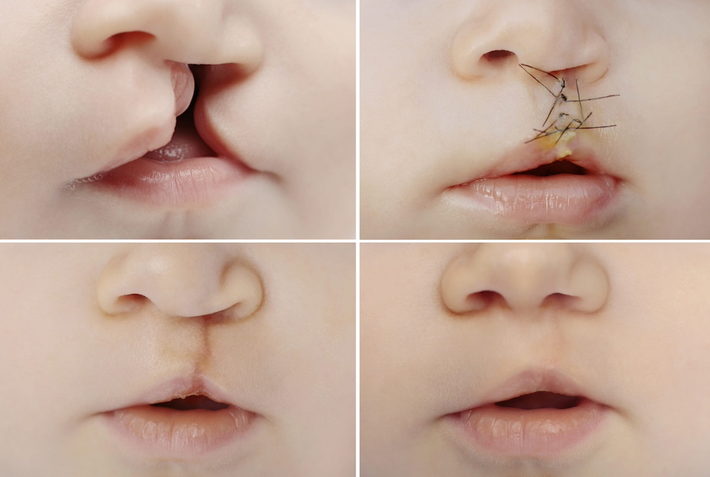 Cleft Lip and Palate Repair