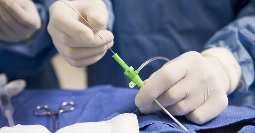 Embolization Therapy