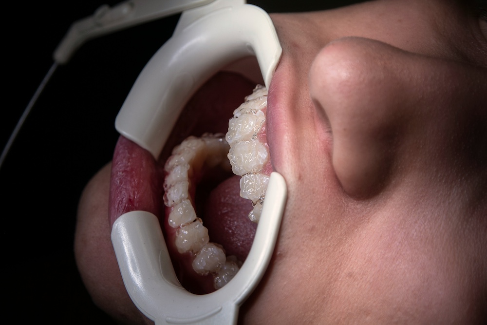 Corrective Jaw Surgery (Orthognathic Surgery)