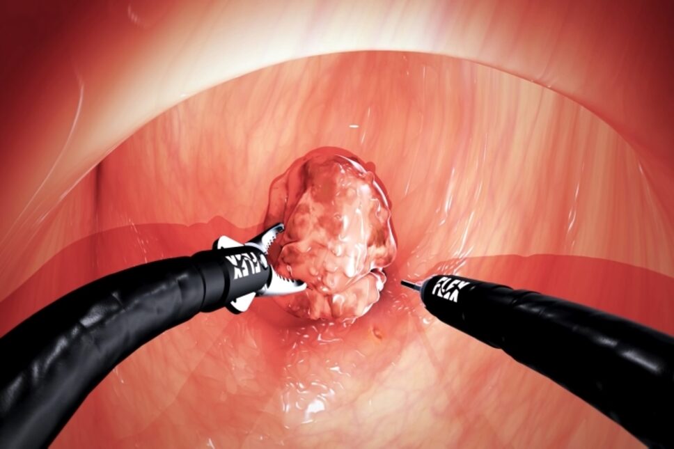 Tumour Resection