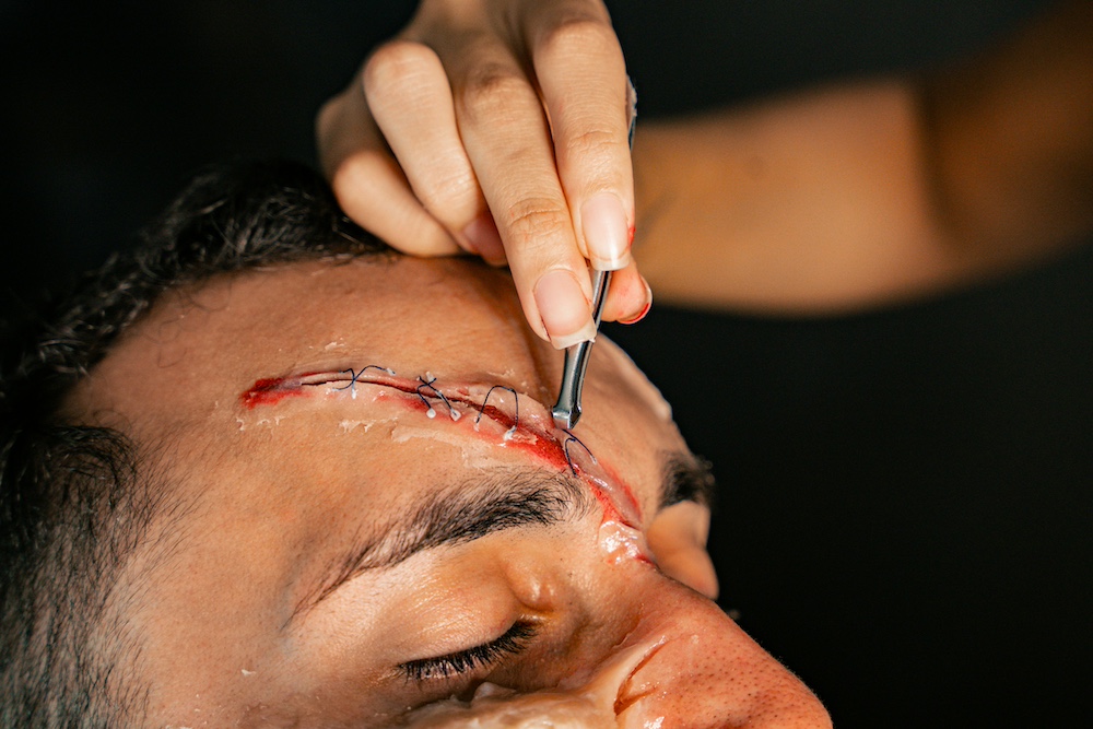 Facial Trauma Surgery