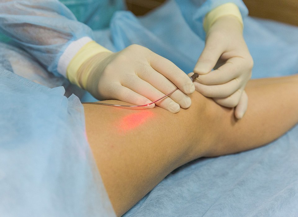 Endovenous Laser Therapy (EVLT)