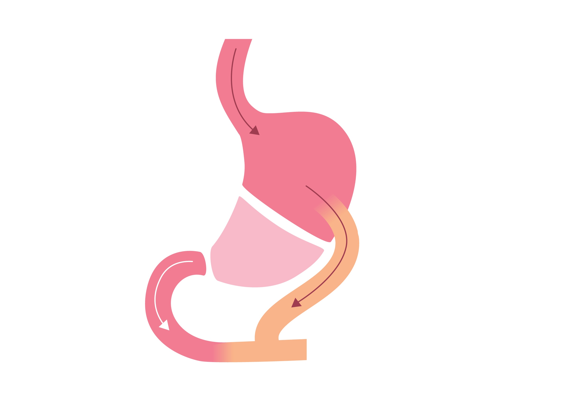 Biliopancreatic Diversion with Duodenal Switch (BPD/DS)