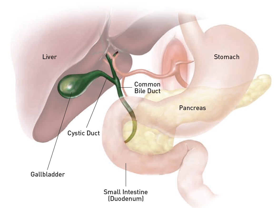 Cholecystectomy