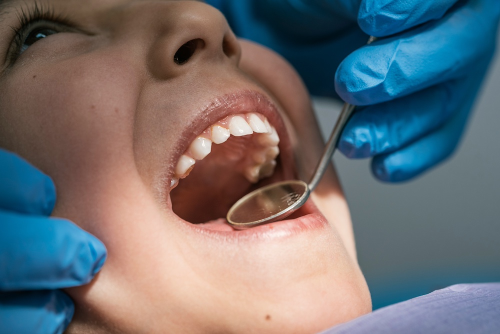 Wisdom Teeth Removal