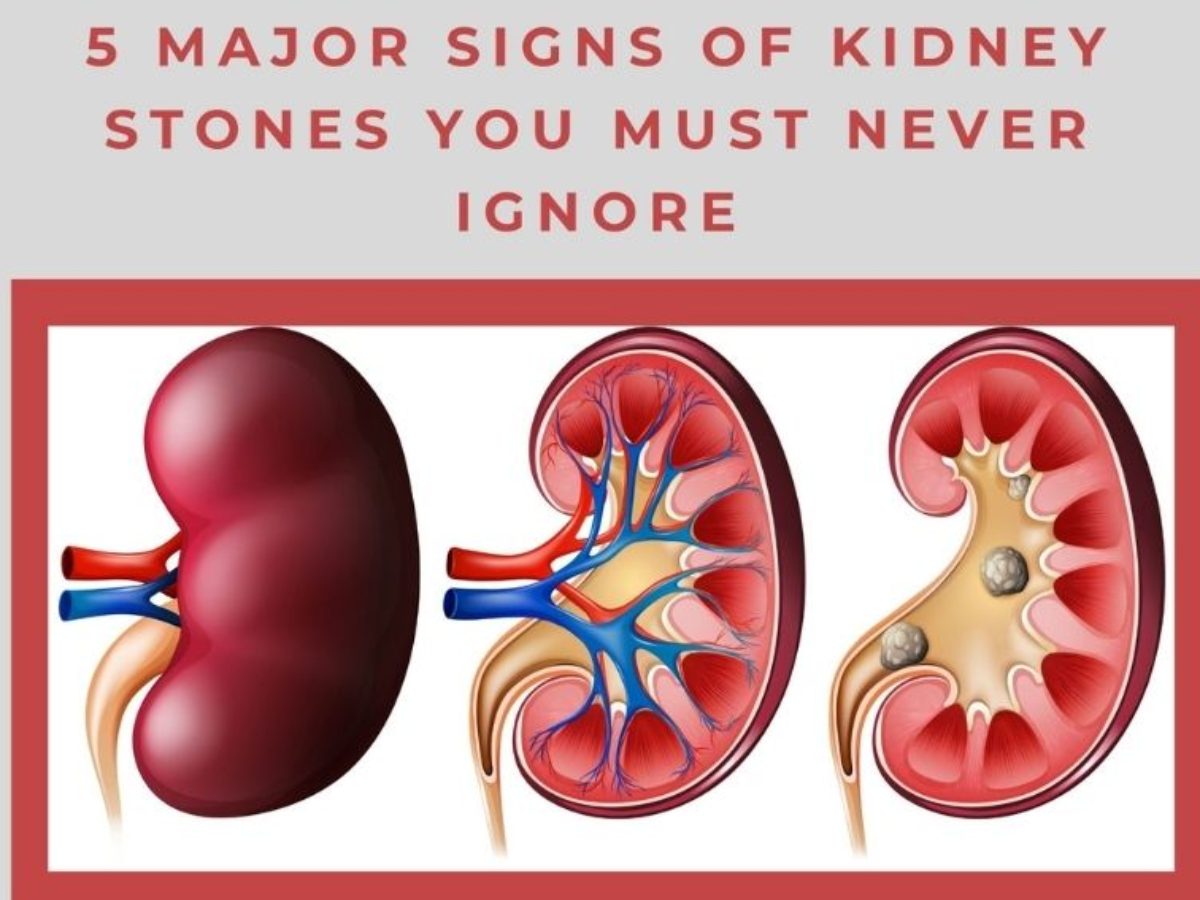 Kidney Stones – A Likely Cause of Flank Pain That Should Not Be Ignored